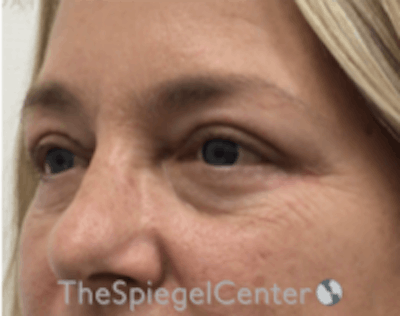 Blepharoplasty Before & After Gallery - Patient 157139834 - Image 4