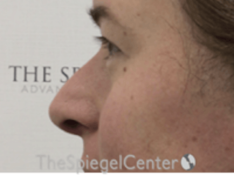 Cheek Implants Before & After Gallery - Patient 157139835 - Image 1