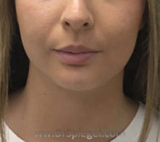 Chin Augmentation Before & After Gallery - Patient 157139839 - Image 2