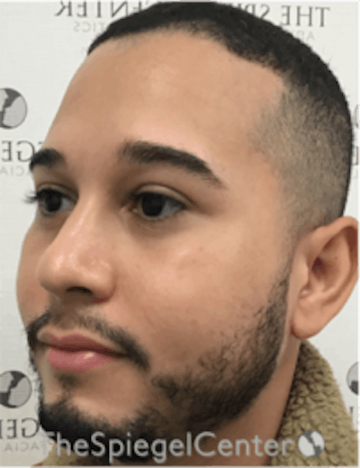 Buccal Fat Reduction Before & After Gallery - Patient 157139838 - Image 3