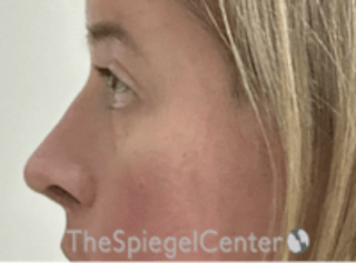 Cheek Implants Before & After Gallery - Patient 157139835 - Image 2
