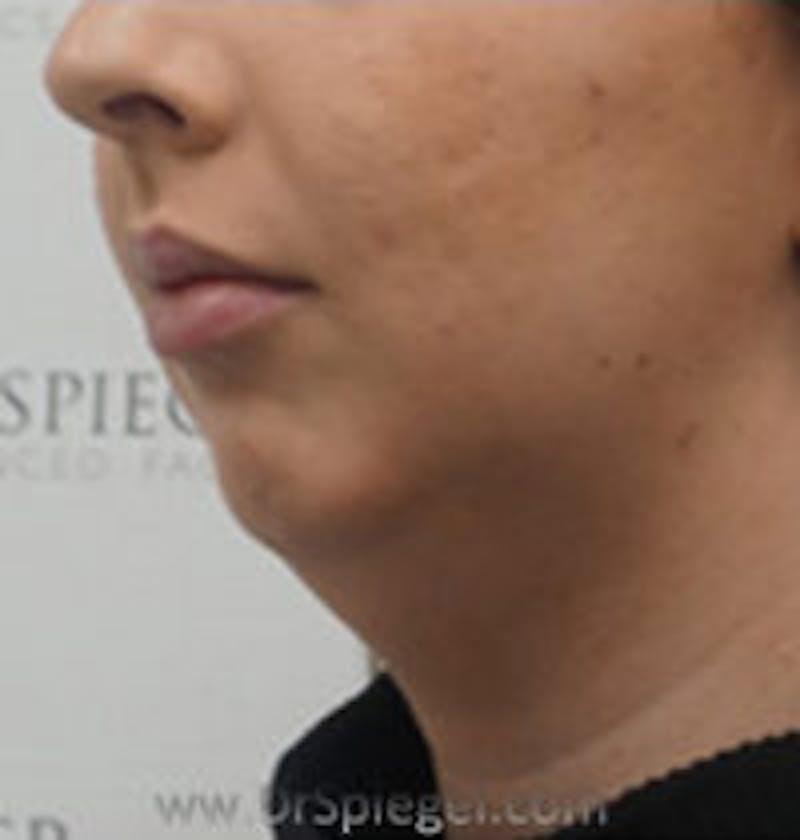 Chin Augmentation Before & After Gallery - Patient 157139839 - Image 3