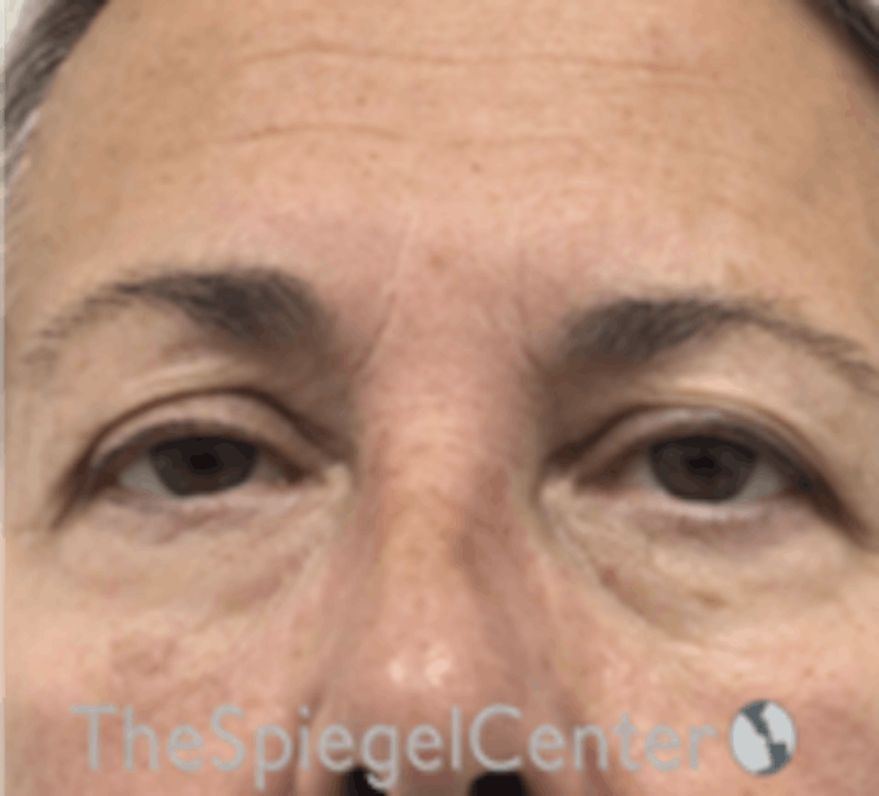 Blepharoplasty Before & After Gallery - Patient 157139842 - Image 1