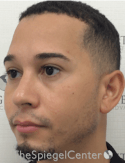 Buccal Fat Reduction Before & After Gallery - Patient 157139838 - Image 4