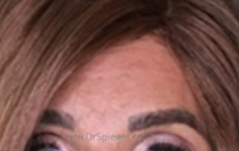 Browlift / Fox Eye Lift Before & After Gallery - Patient 157139836 - Image 2
