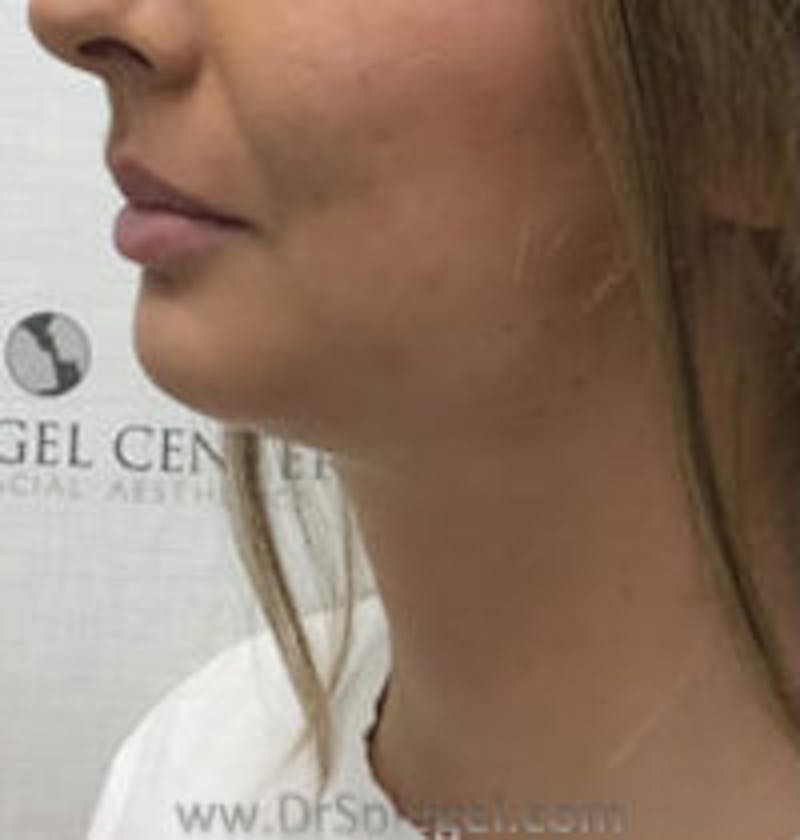 Chin Augmentation Before & After Gallery - Patient 157139839 - Image 4