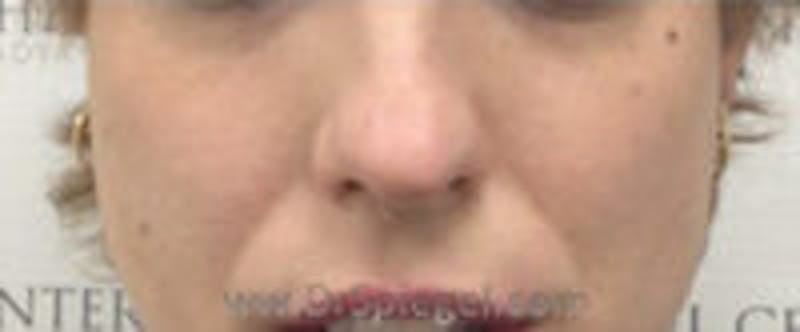 Cheek Implants Before & After Gallery - Patient 157139841 - Image 3