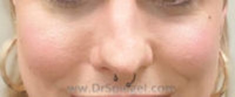Cheek Implants Before & After Gallery - Patient 157139841 - Image 4