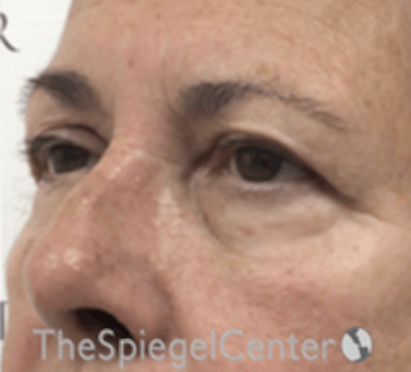Blepharoplasty Before & After Gallery - Patient 157139842 - Image 3