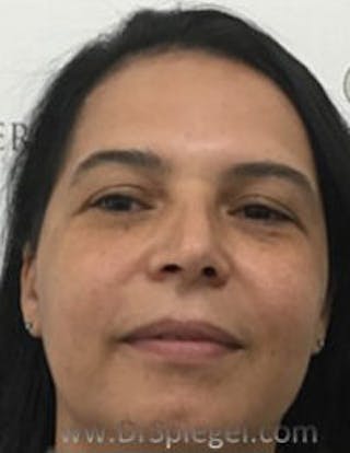 Buccal Fat Reduction Before & After Gallery - Patient 157139843 - Image 2