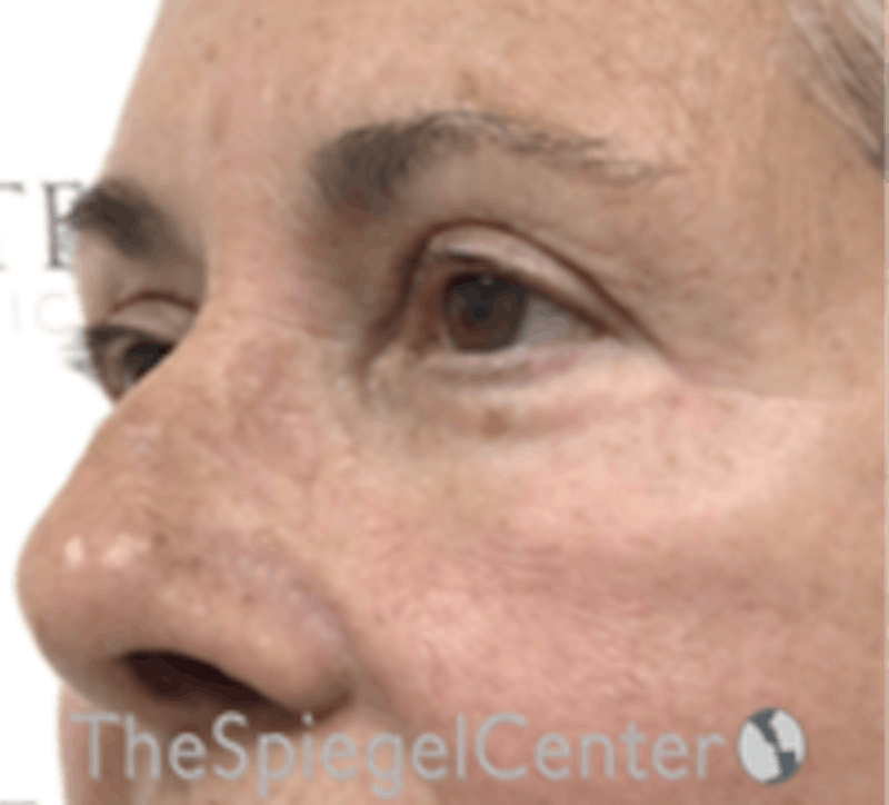 Blepharoplasty Before & After Gallery - Patient 157139842 - Image 4