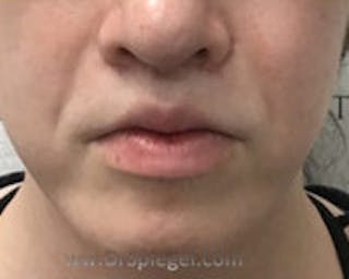 Chin Augmentation Before & After Gallery - Patient 157139844 - Image 2