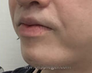 Chin Augmentation Before & After Gallery - Patient 157139844 - Image 4