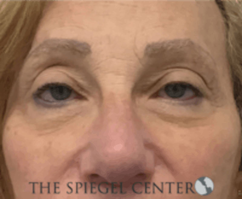 Blepharoplasty Before & After Gallery - Patient 157139848 - Image 1