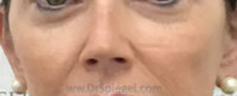 Cheek Implants Before & After Gallery - Patient 157139847 - Image 3