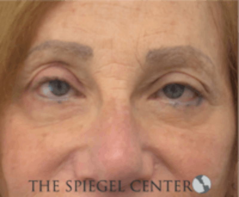 Blepharoplasty Before & After Gallery - Patient 157139848 - Image 2