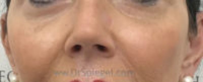 Cheek Implants Before & After Gallery - Patient 157139847 - Image 4