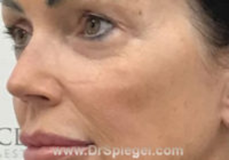 Cheek Augmentation