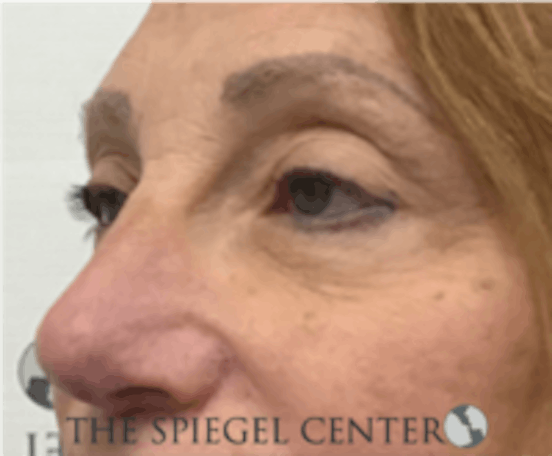 Blepharoplasty Before & After Gallery - Patient 157139848 - Image 3