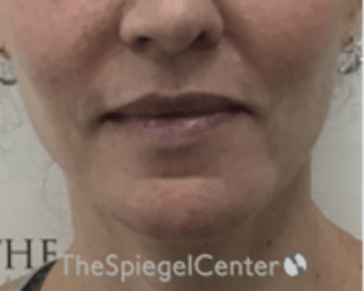 Chin Augmentation Before & After Gallery - Patient 166254406 - Image 1