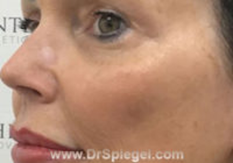 Cheek Augmentation