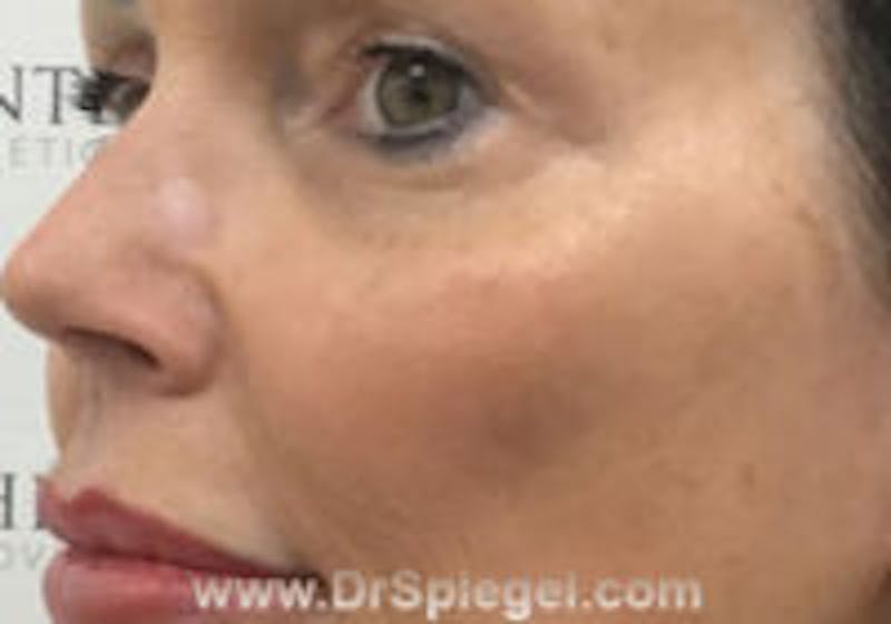 Cheek Implants Before & After Gallery - Patient 157139847 - Image 2