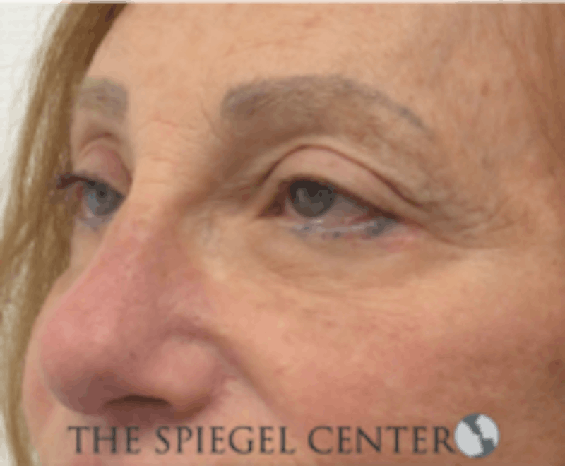Blepharoplasty Before & After Gallery - Patient 157139848 - Image 4