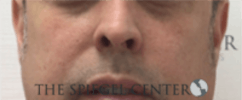 Cheek Implants Before & After Gallery - Patient 157139858 - Image 3