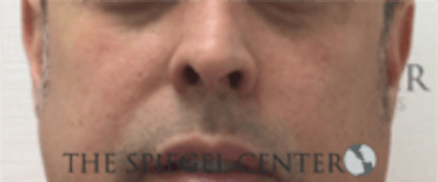 Cheek Implants Before & After Gallery - Patient 157139858 - Image 3