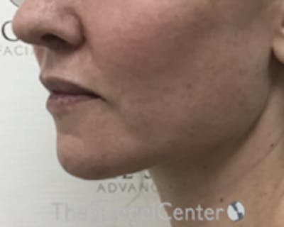 Chin Augmentation Before & After Gallery - Patient 166254406 - Image 3