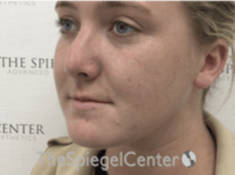Buccal Fat Reduction Before & After Gallery - Patient 157139851 - Image 4