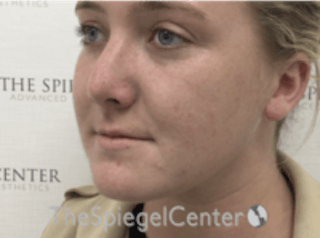 Buccal Fat Reduction Before & After Gallery - Patient 157139851 - Image 4