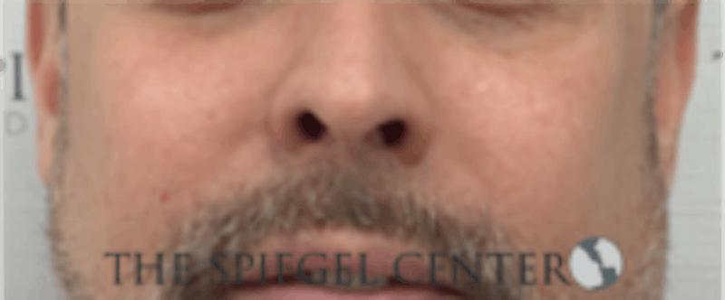 Cheek Implants Before & After Gallery - Patient 157139858 - Image 4
