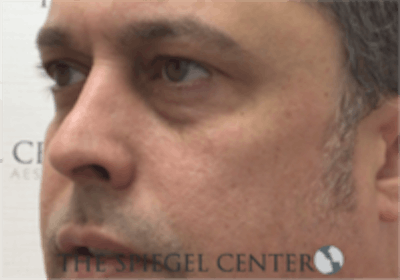 Cheek Implants Before & After Gallery - Patient 157139858 - Image 1