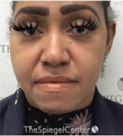 Buccal Fat Reduction Before & After Gallery - Patient 157139860 - Image 1