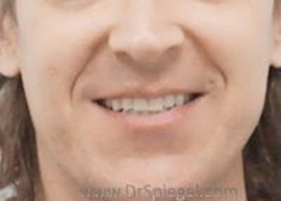 Dimpleplasty Before & After Gallery - Patient 157139862 - Image 1