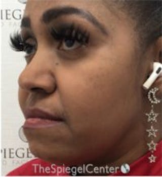 Buccal Fat Reduction Before & After Gallery - Patient 157139860 - Image 4