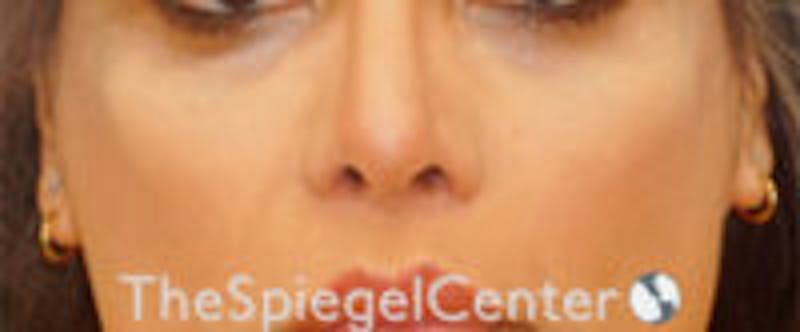 Cheek Implants Before & After Gallery - Patient 157139866 - Image 4