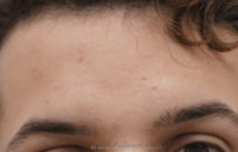 Browlift / Fox Eye Lift Before & After Gallery - Patient 157139865 - Image 1
