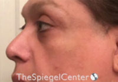 Cheek Implants Before & After Gallery - Patient 157139866 - Image 1