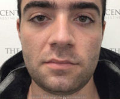 Buccal Fat Reduction Before & After Gallery - Patient 157139872 - Image 2