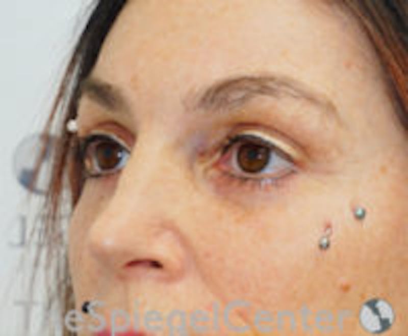 Blepharoplasty Before & After Gallery - Patient 157139869 - Image 4
