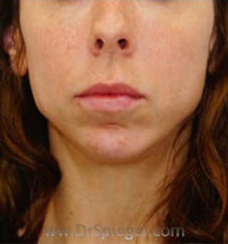 Chin Augmentation Before & After Gallery - Patient 157139871 - Image 2
