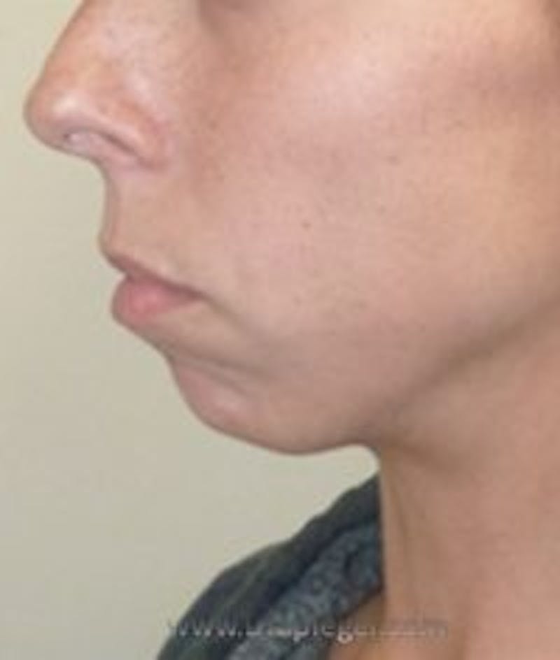 Chin Augmentation Before & After Gallery - Patient 157139871 - Image 3