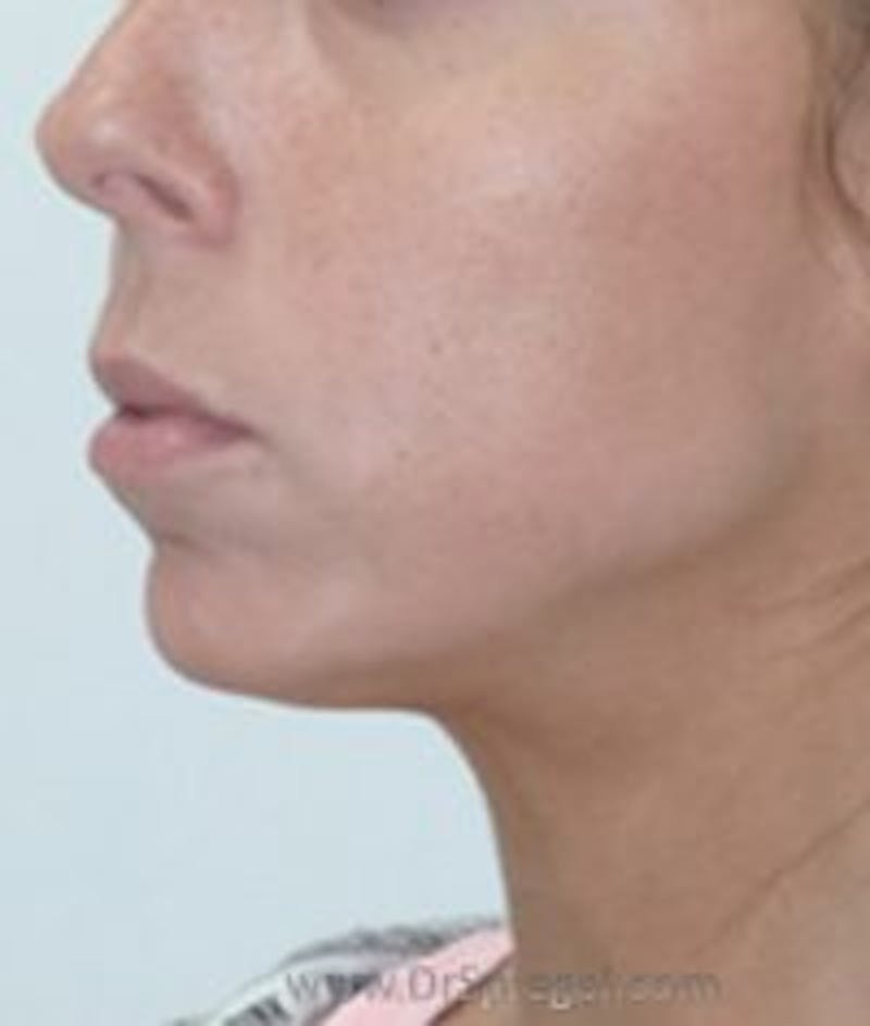Chin Augmentation Before & After Gallery - Patient 157139871 - Image 4