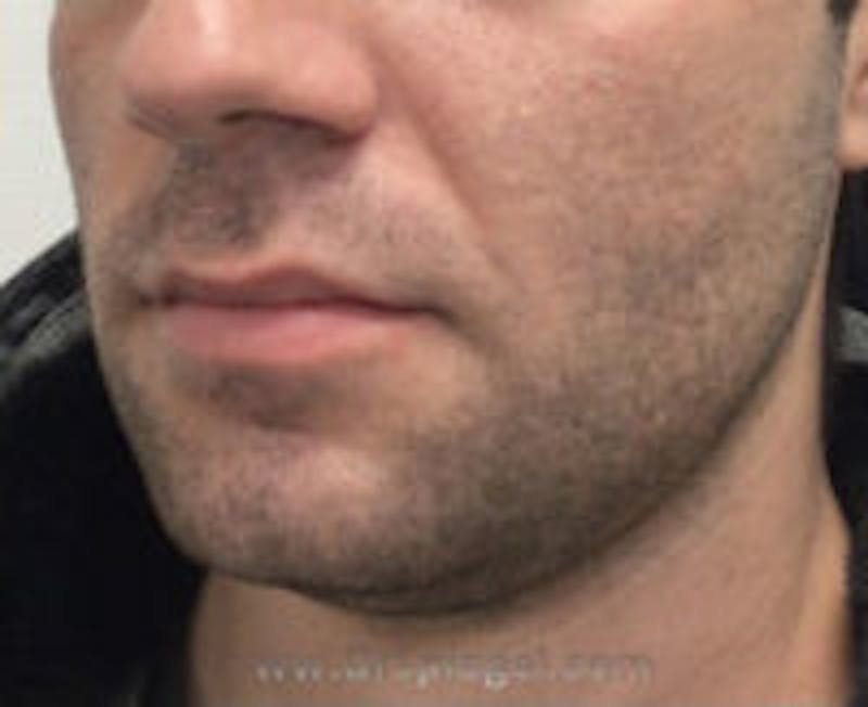 Buccal Fat Reduction Before & After Gallery - Patient 157139872 - Image 4