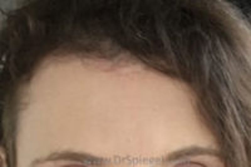 Browlift / Fox Eye Lift Before & After Gallery - Patient 157139873 - Image 2