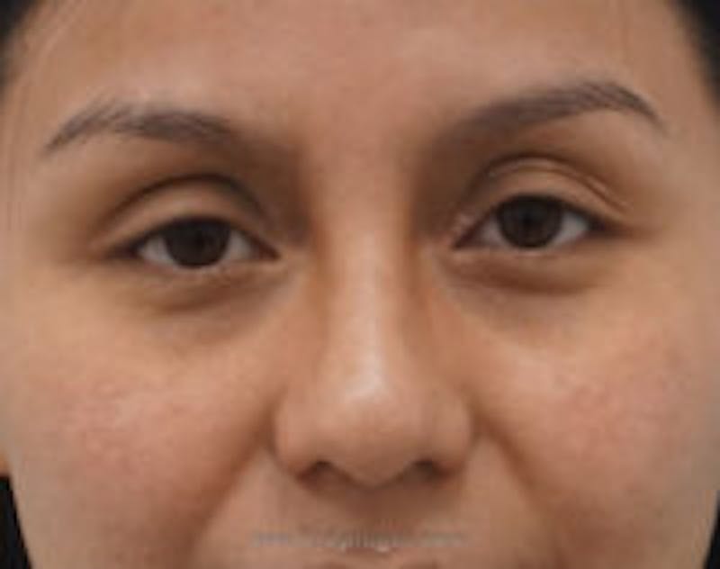 Blepharoplasty Before & After Gallery - Patient 157139875 - Image 2