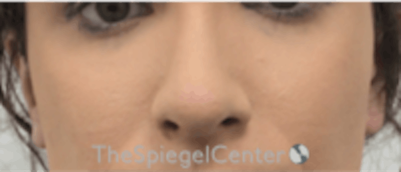 Cheek Implants Before & After Gallery - Patient 157139879 - Image 4