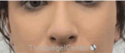 Cheek Implants Before & After Gallery - Patient 157139879 - Image 4